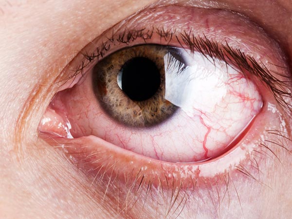 كثرة الدموع تسبب تهيج واحمرار بالعين