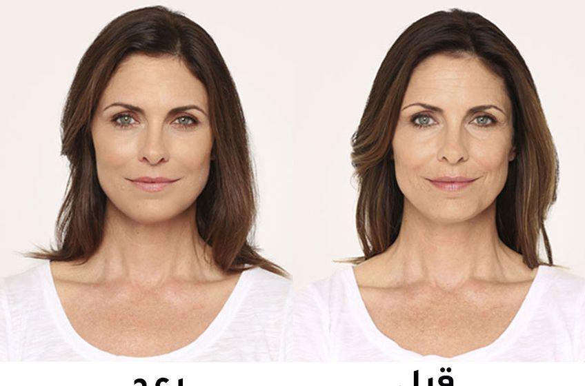 مادة البوتوكس الطبيعية لشد البشرة مع تأثير رائع